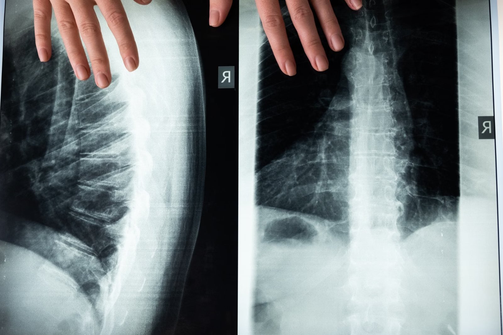 X-ray images of a spine