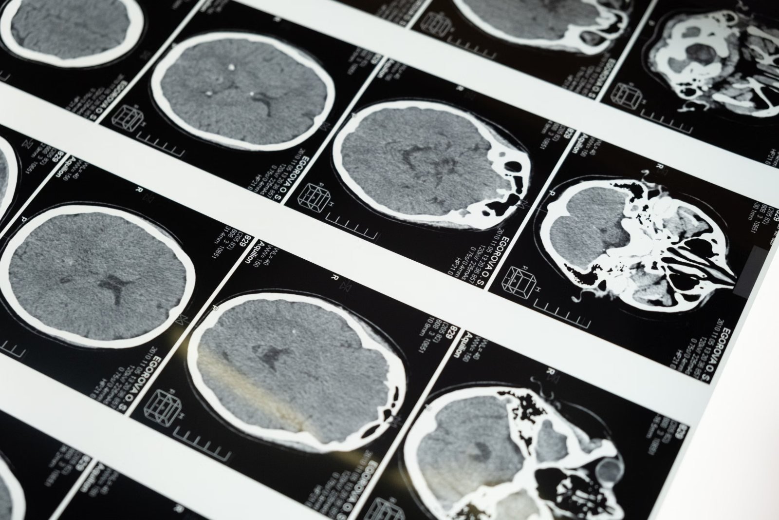 Head scan films laid out on a light box