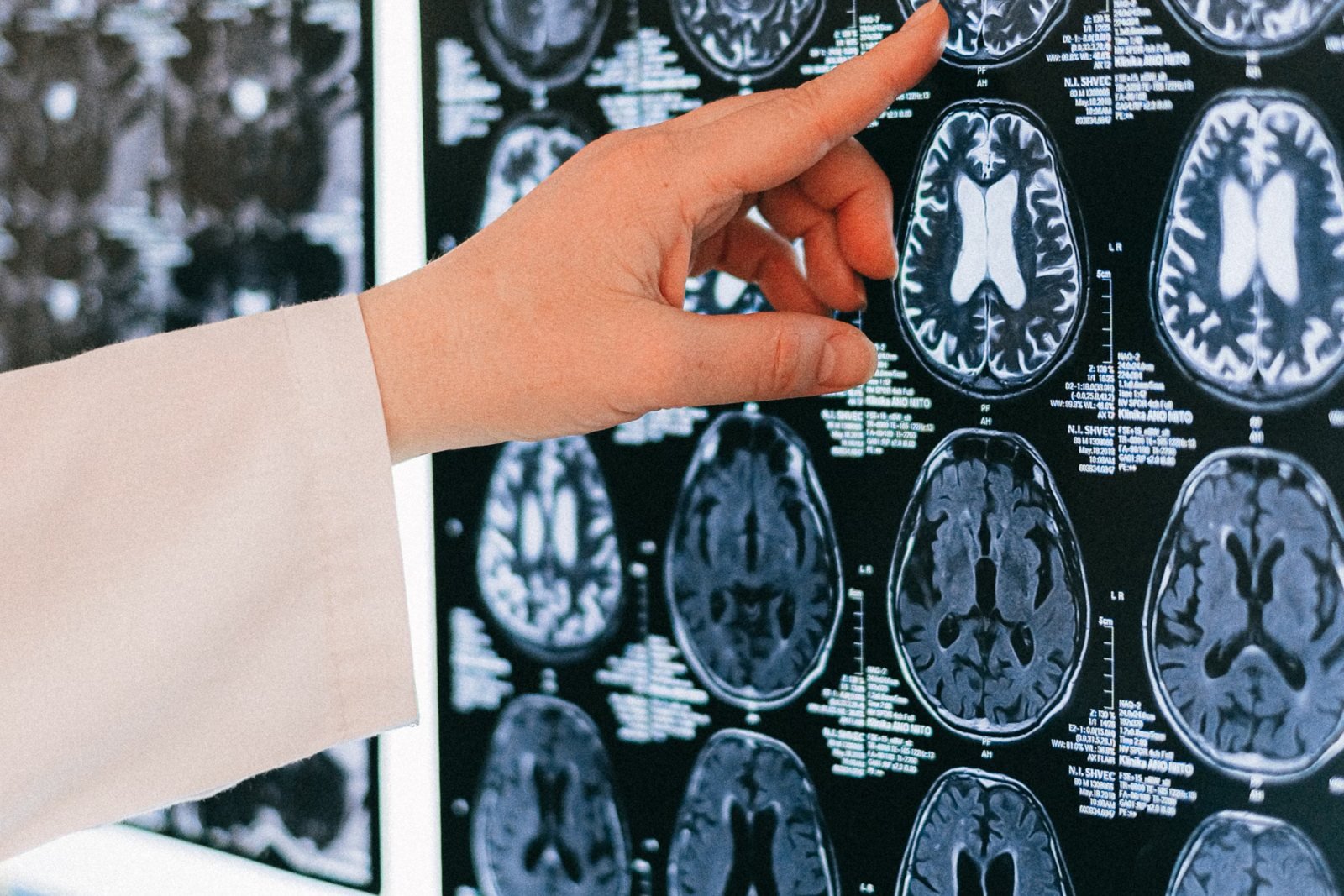 A clinician pointing out detail on MRI images on a light box