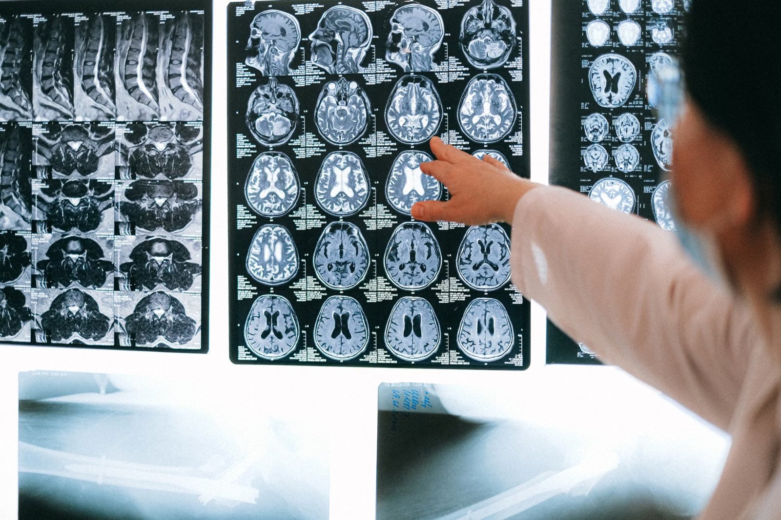 A clinician pointing at brain MRI images