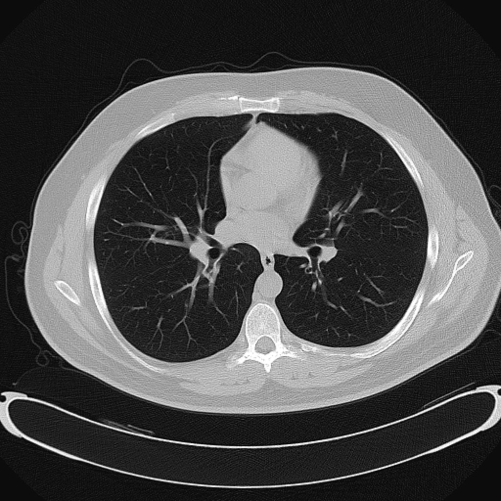 A CT scan of the chest, showing the lungs and heart in cross-section