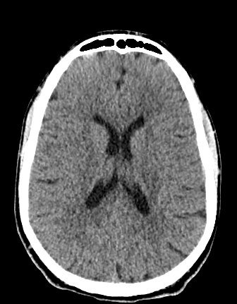 Head CT: A normal head CT. CT is quick, which is why it is often used for head injuries.
