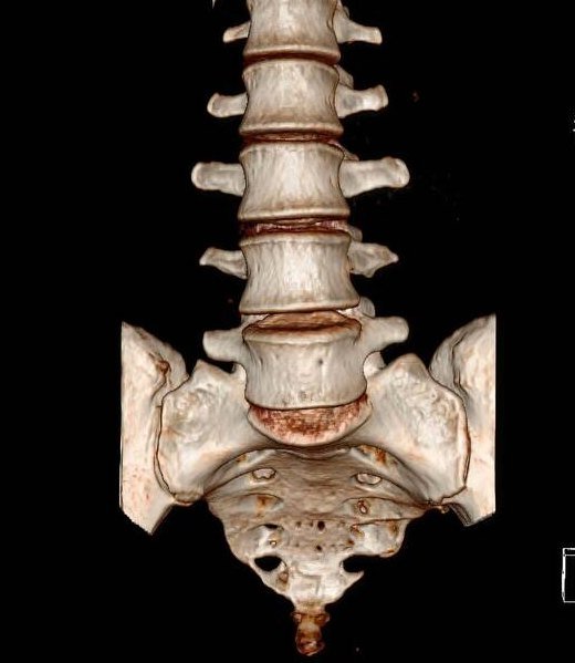 3D CT of the lower spine: CT data turned into a 3D picture of the lower spine and pelvis.