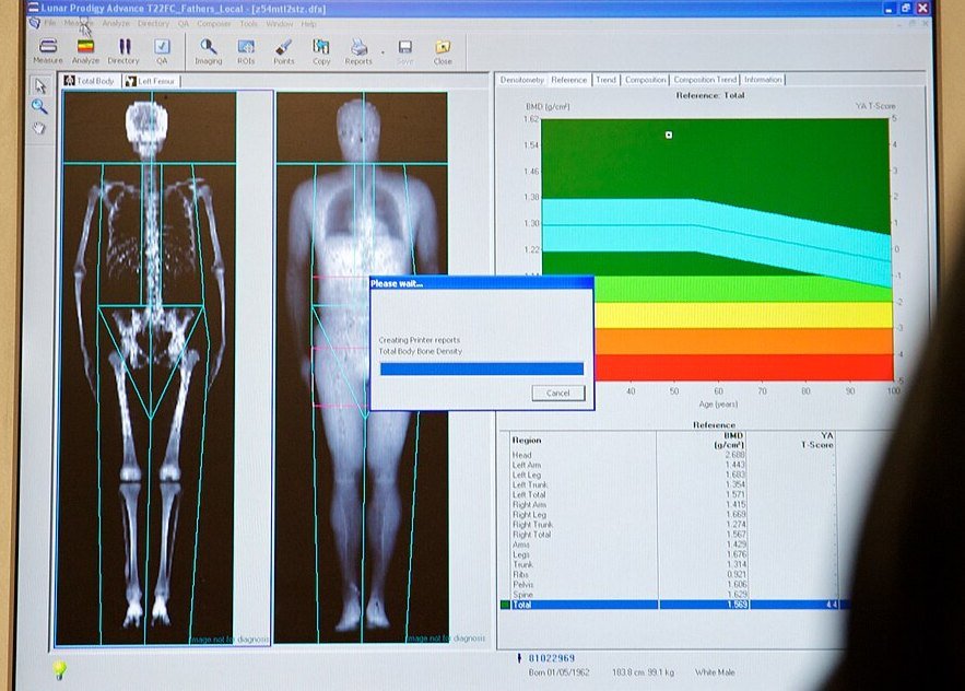 DEXA result: A DEXA result on the reporting screen: whole-body images next to the bone density chart.