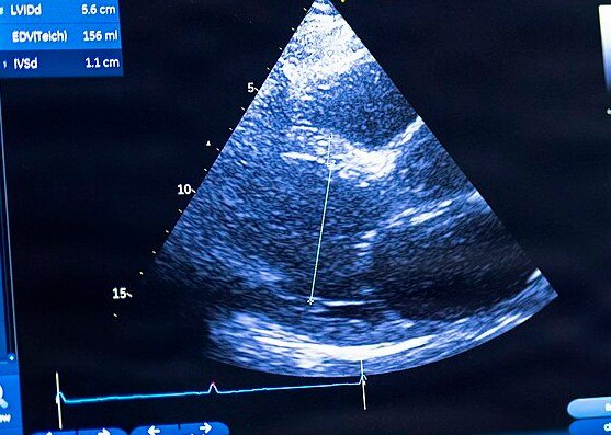 Echocardiogram: An ultrasound of the heart on the scanner screen, showing the heart's chambers and valves.