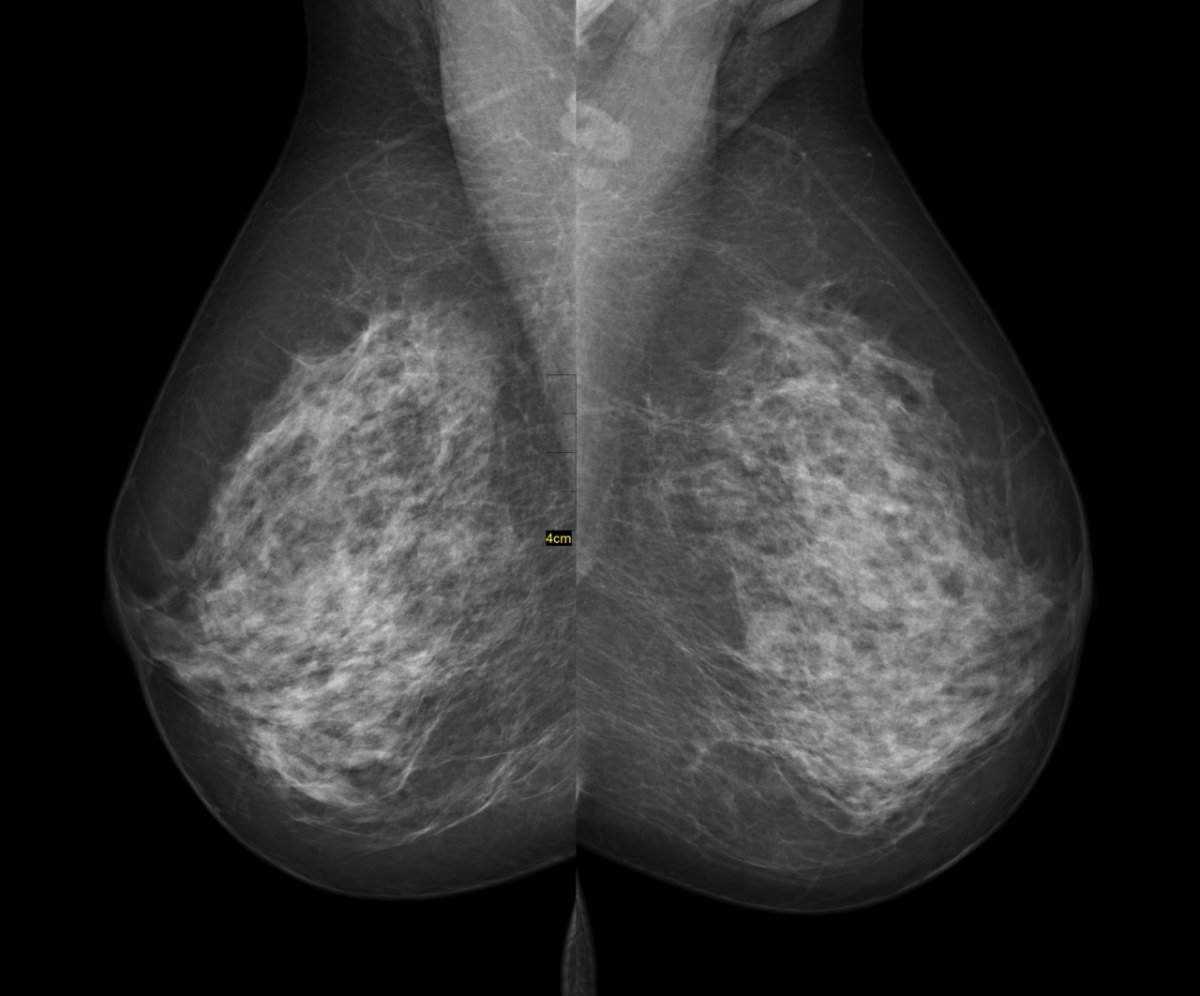 Mammogram: Both breasts, imaged from the side at an angle (the standard 'MLO' view).