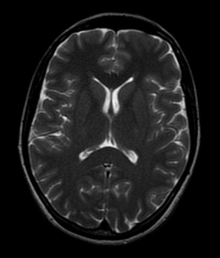 Brain MRI, from above: A normal brain, as if looking down through the top of the head.