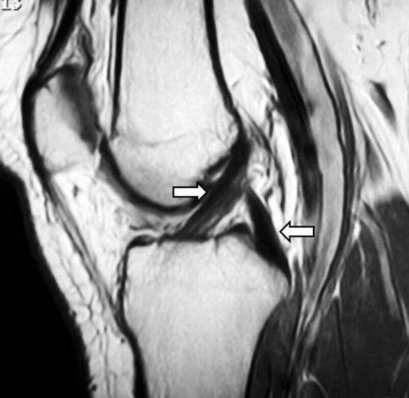 Knee MRI: A side view of the knee. The arrows point to the two cruciate ligaments, shown here as normal. MRI shows ligaments and cartilage that X-rays cannot.