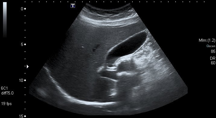 Gallbladder ultrasound: A normal gallbladder and bile duct. The gallbladder holds fluid, so it shows up dark.