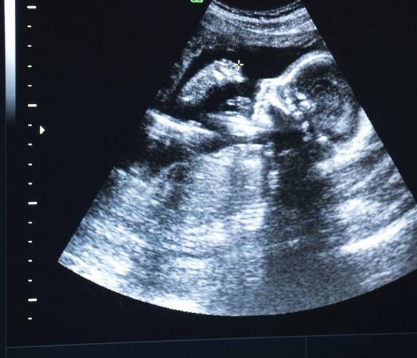 Pregnancy ultrasound: The familiar pregnancy scan, shown live on the scanner's screen: a baby in profile at about 20 weeks.
