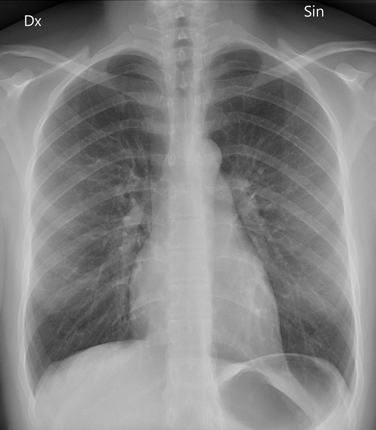 Chest X-ray: A normal chest X-ray, showing the lungs, the outline of the heart and the ribs.