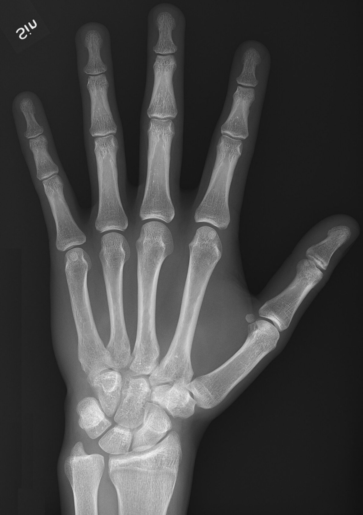 Hand X-ray: A normal hand and wrist. X-rays show bone clearly and are the usual first test for a suspected fracture.
